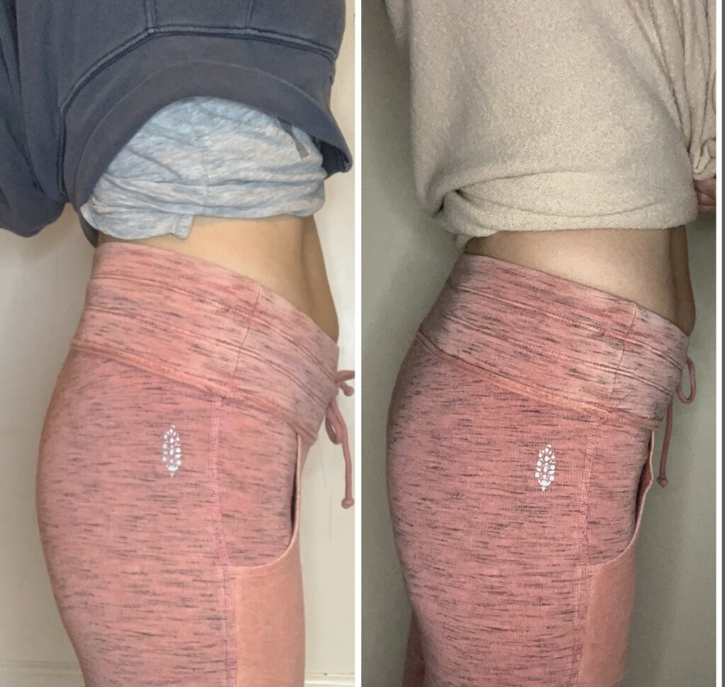 Non Surgical Butt Lift Before and After Photo